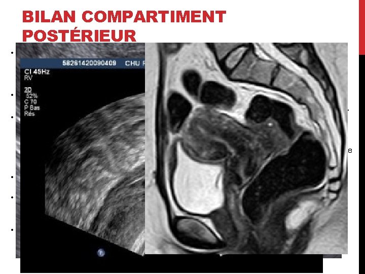BILAN COMPARTIMENT POSTÉRIEUR • Recherche: • Adénomyose externe • Lésion intestinale: nombre, taille, infiltration