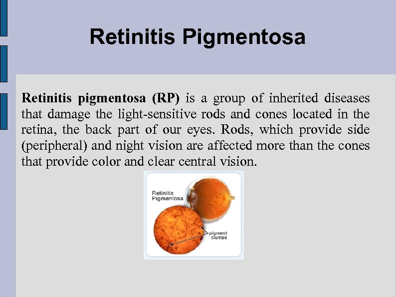 Retinitis Pigmentosa Retinitis pigmentosa (RP) is a group of inherited diseases that damage the
