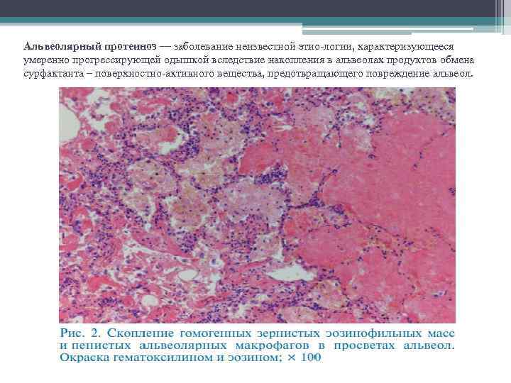 Альвеолярный протеиноз — заболевание неизвестной этио логии, характеризующееся умеренно прогрессирующей одышкой вследствие накопления в