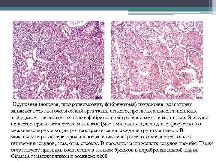  Крупозная (долевая, плевропневмония, фибринозная) пневмония: воспаление занимает весь гистологический срез ткани легкого, просветы