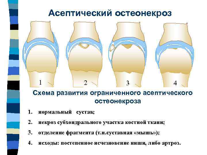 Асептический некроз коленного сустава лечение