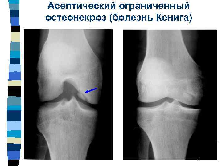 Болезнь кенига презентация