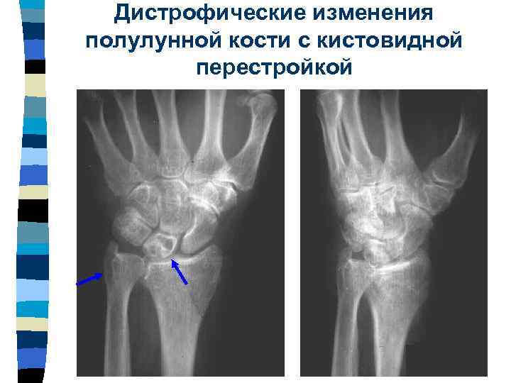 Единичное кистовидное просветление. Кистовидная перестройка ладьевидной кости. Подвывих ладьевидной кости кисти рентген. Подвывих ладьевидной кости кисти. Кистовидная перестройка костей коленного сустава.