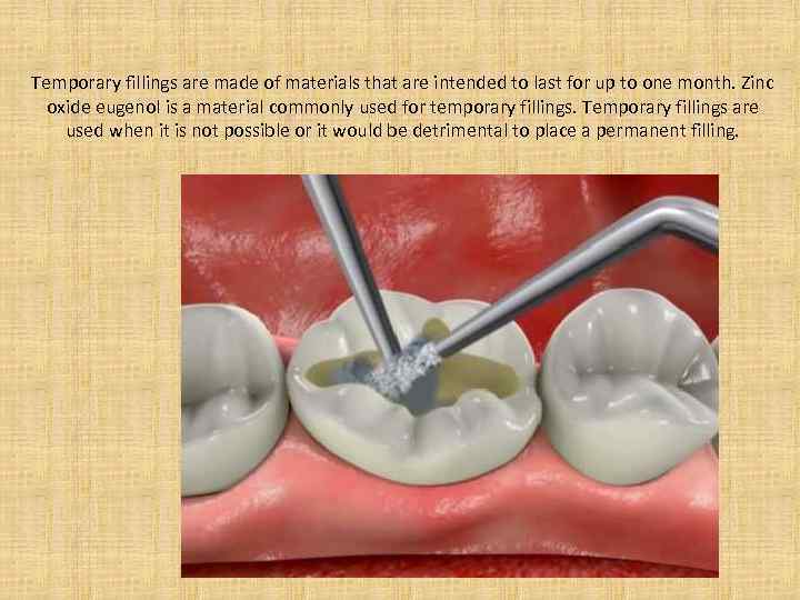Temporary fillings are made of materials that are intended to last for up to