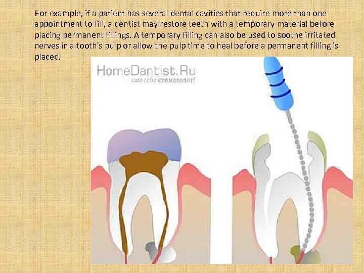  For example, if a patient has several dental cavities that require more than