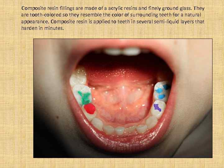 Composite resin fillings are made of a acrylic resins and finely ground glass.