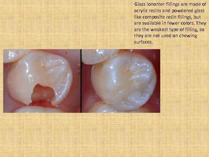  Glass ionomer fillings are made of acrylic resins and powdered glass like composite