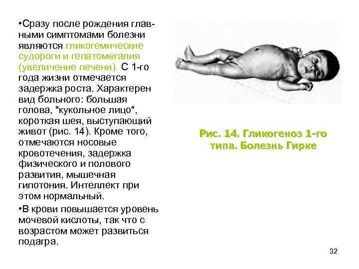  • Сразу после рождения главными симптомами болезни являются гликогемические судороги и гепатомегалия (увеличение