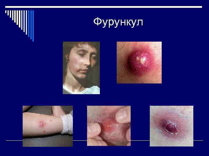 Фурункул 