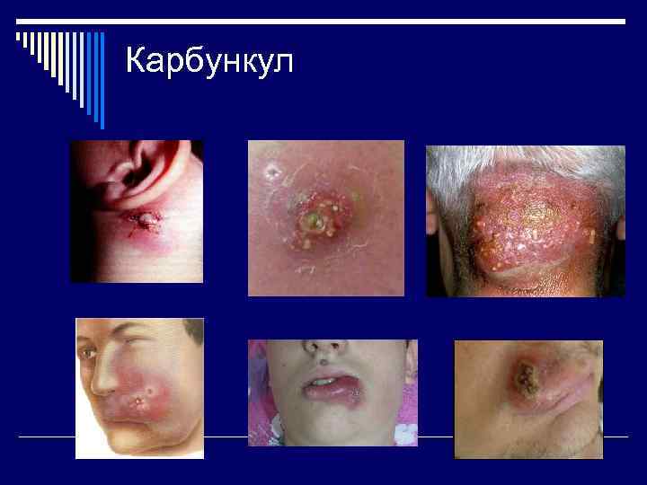 Карбункул 