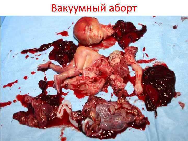 Вакуумный аборт 