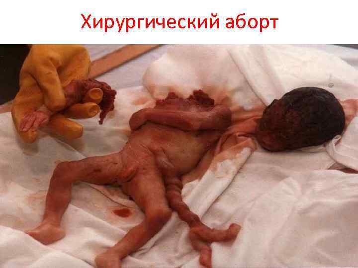 Хирургический аборт 