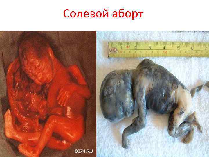 Солевой аборт 