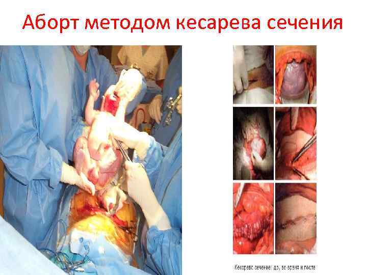 Аборт методом кесарева сечения 