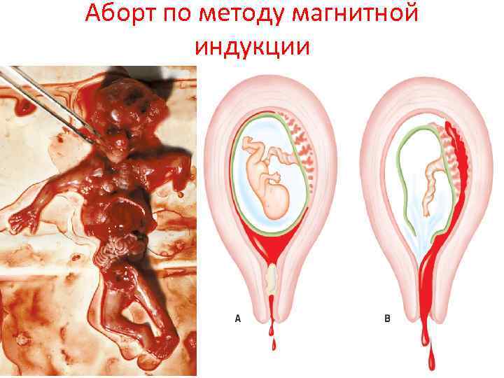 Аборт по методу магнитной индукции 