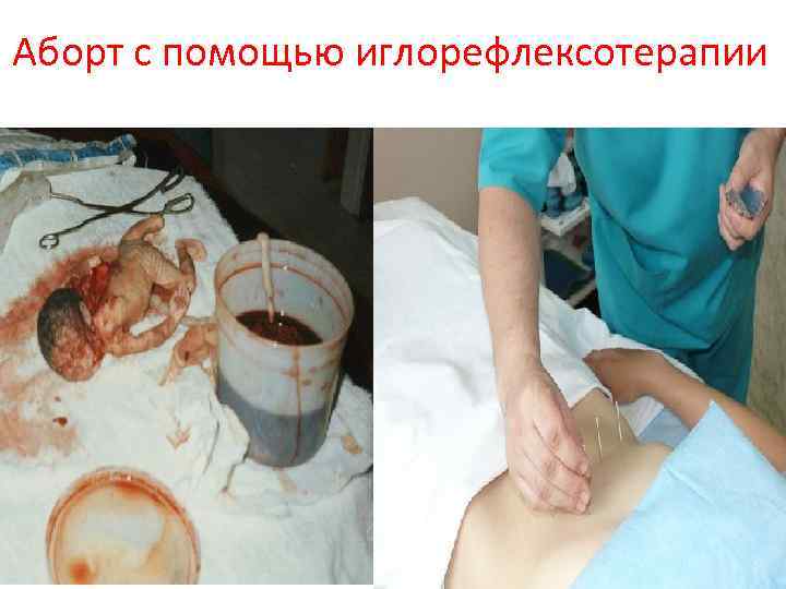 Аборт с помощью иглорефлексотерапии 