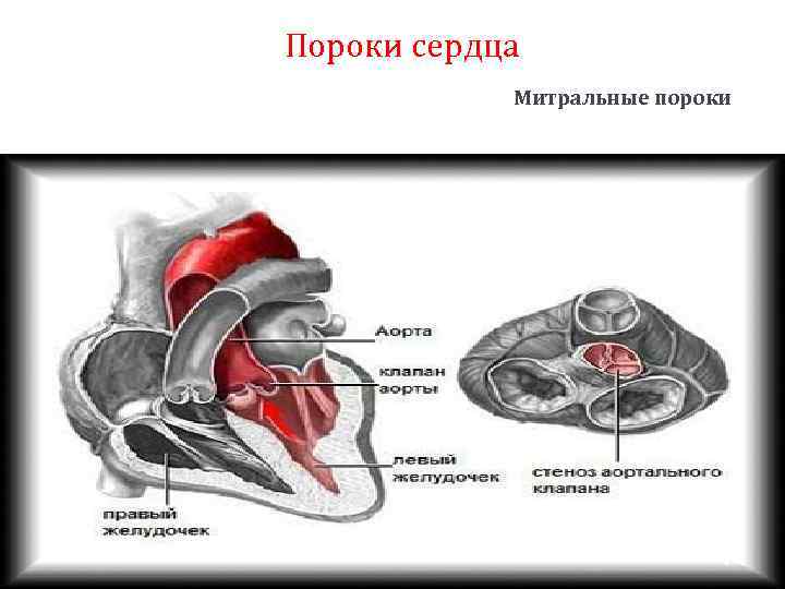 Пороки сердца Митральные пороки 