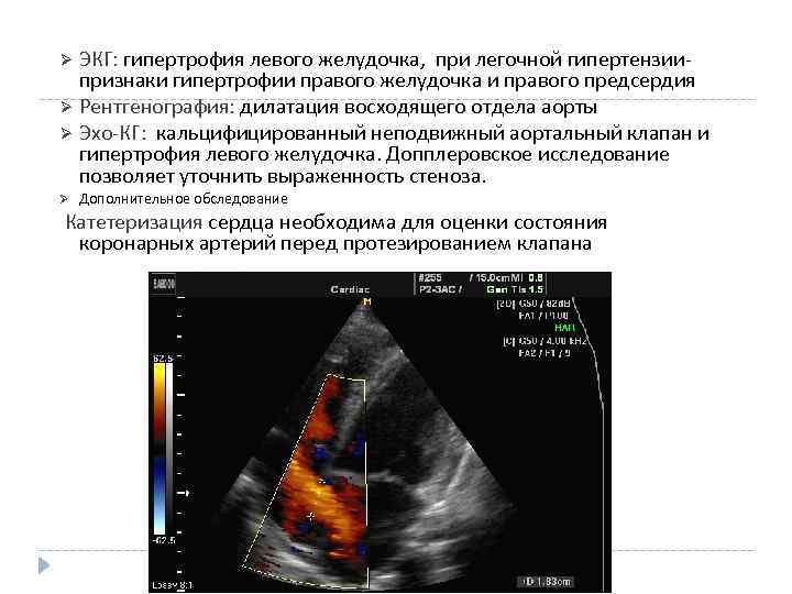 ЭКГ: гипертрофия левого желудочка, при легочной гипертензиипризнаки гипертрофии правого желудочка и правого предсердия Ø