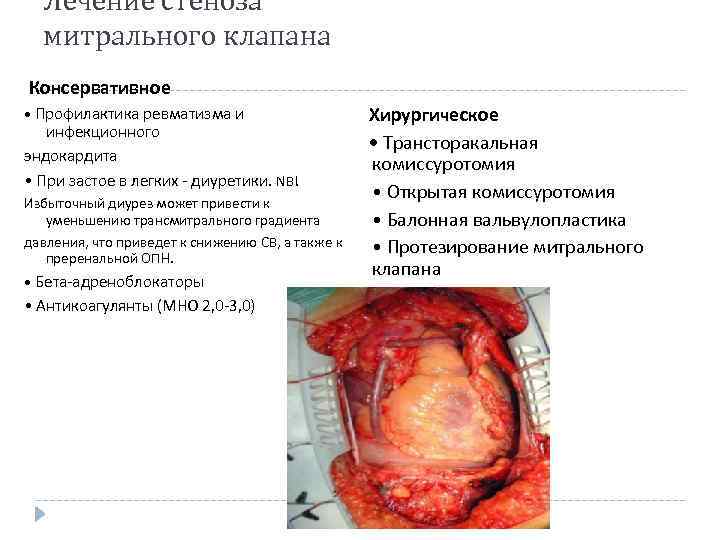 Лечение стеноза митрального клапана Консервативное Хирургическое • Трансторакальная комиссуротомия • Открытая комиссуротомия • Балонная