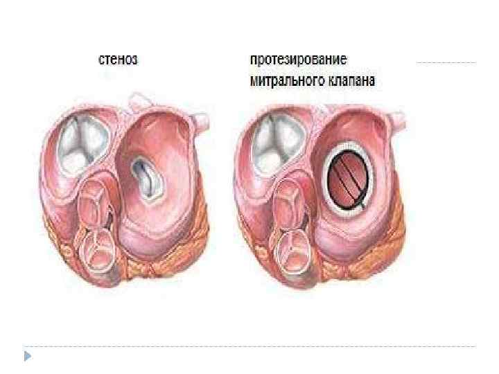 Стеноз митрального клапана. Стеноз митрального клапапа. Стеноз митрального клапана сердца.