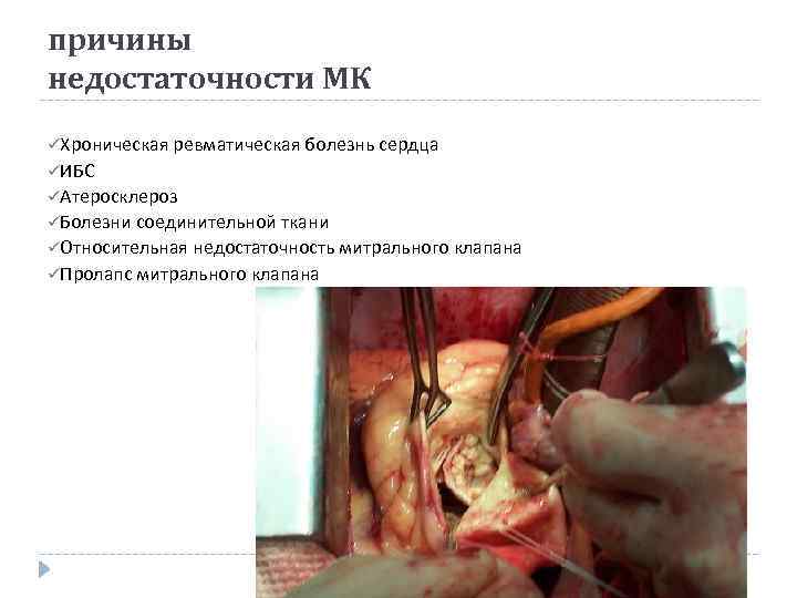 причины недостаточности МК üХроническая ревматическая болезнь сердца üИБС üАтеросклероз üБолезни соединительной ткани üОтносительная недостаточность