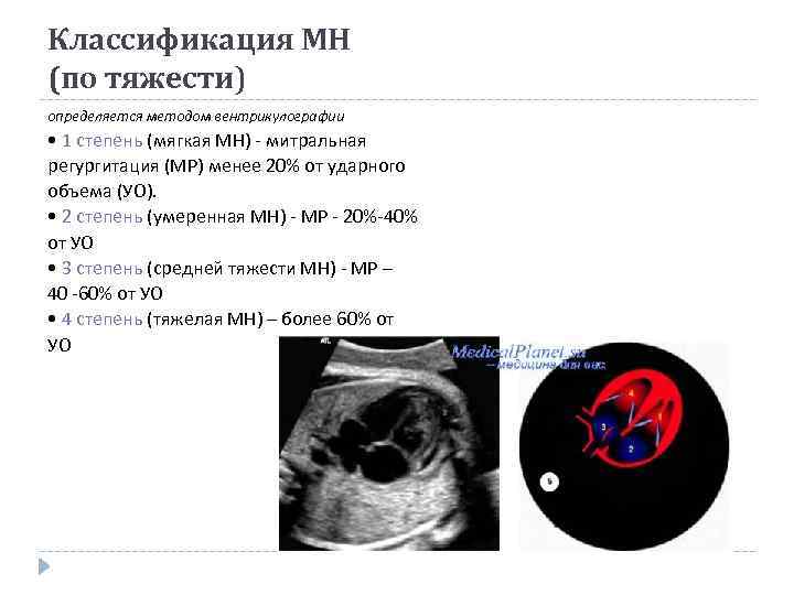 Классификация МН (по тяжести) определяется методом вентрикулографии • 1 степень (мягкая МН) - митральная