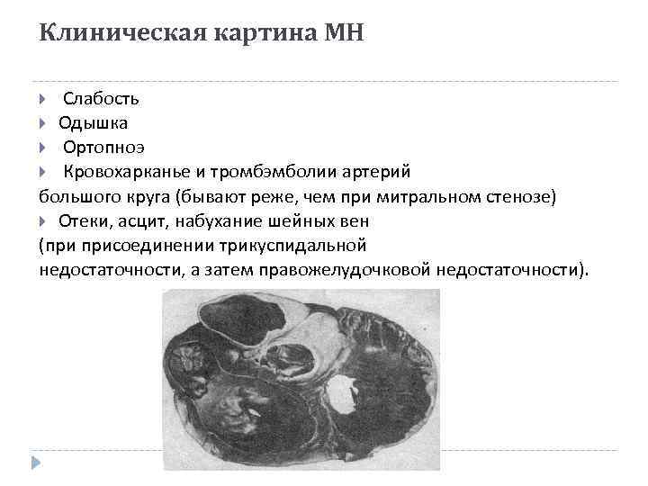 Клиническая картина МН Слабость Одышка Ортопноэ Кровохарканье и тромбэмболии артерий большого круга (бывают реже,