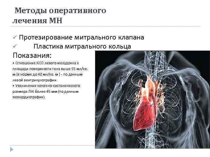 Методы оперативного лечения МН ü Протезирование митрального клапана ü Пластика митрального кольца Показания: •