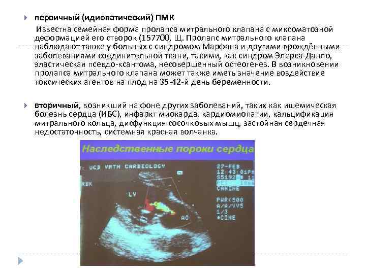 первичный (идиопатический) ПМК Известна семейная форма пролапса митрального клапана с миксоматозной деформацией его створок