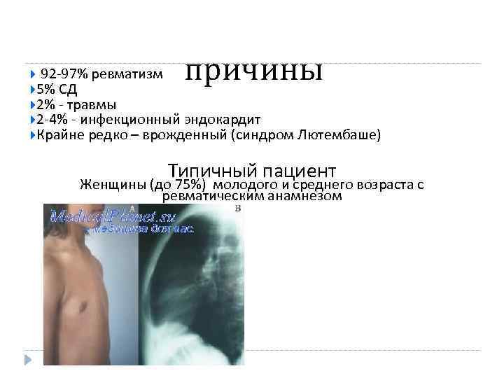 причины 92 -97% ревматизм 5% СД 2% - травмы 2 -4% - инфекционный эндокардит