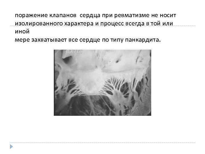 поражение клапанов сердца при ревматизме не носит изолированного характера и процесс всегда в той