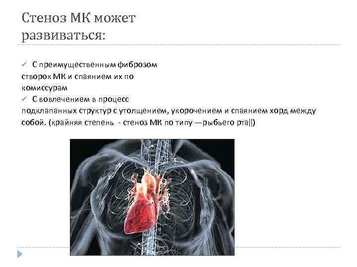 Стеноз МК может развиваться: С преимущественным фиброзом створок МК и спаянием их по комиссурам