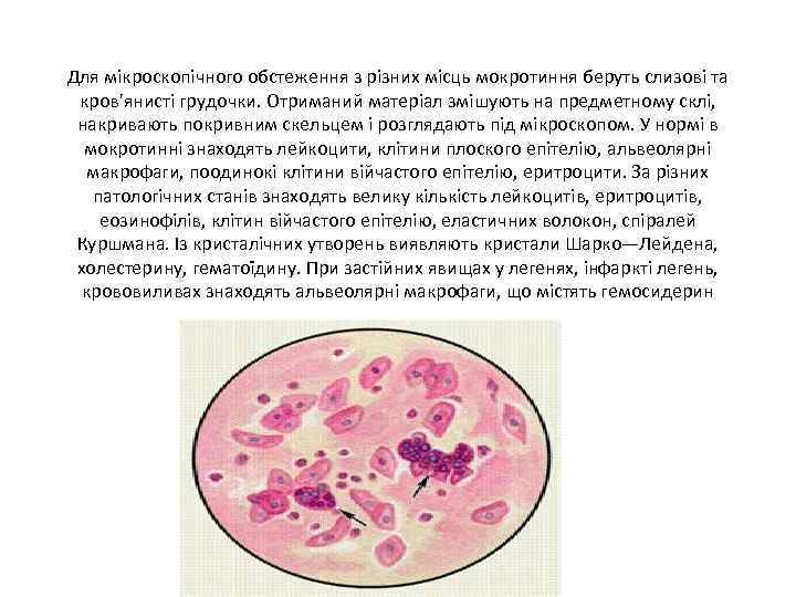 Для мікроскопічного обстеження з різних місць мокротиння беруть слизові та кров'янисті грудочки. Отриманий матеріал