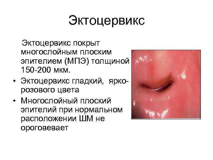 Эктоцервикс покрыт многослойным плоским эпителием (МПЭ) толщиной 150 -200 мкм. • Эктоцервикс гладкий, яркорозового