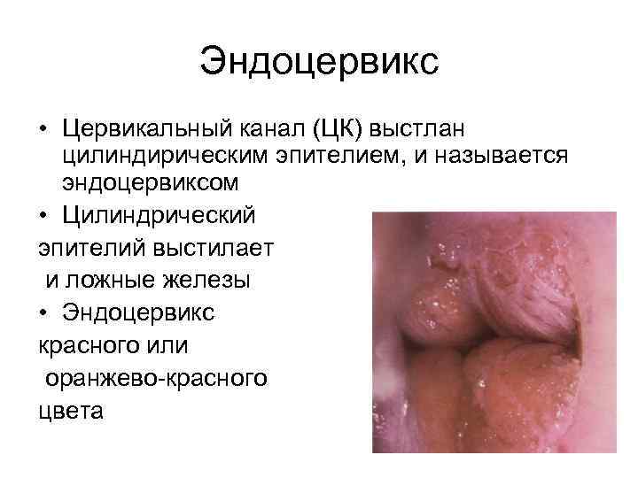 Эндоцервикс • Цервикальный канал (ЦК) выстлан цилиндирическим эпителием, и называется эндоцервиксом • Цилиндрический эпителий