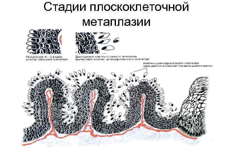 Стадии плоскоклеточной метаплазии 