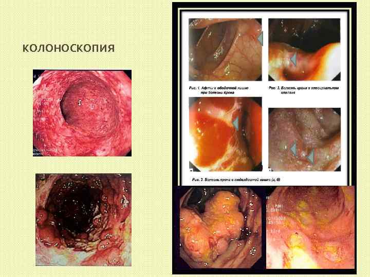 КОЛОНОСКОПИЯ 