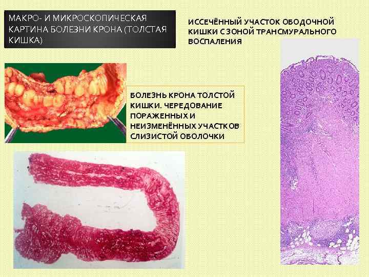 МАКРО- И МИКРОСКОПИЧЕСКАЯ КАРТИНА БОЛЕЗНИ КРОНА (ТОЛСТАЯ КИШКА) ИССЕЧЁННЫЙ УЧАСТОК ОБОДОЧНОЙ КИШКИ С ЗОНОЙ