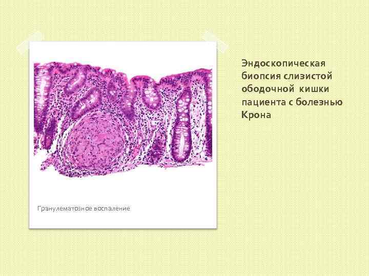 Эндоскопическая биопсия слизистой ободочной кишки пациента с болезнью Крона Гранулематозное воспаление 