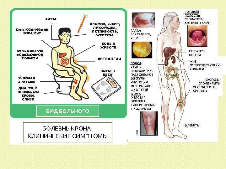 Клиническая картина болезни крона