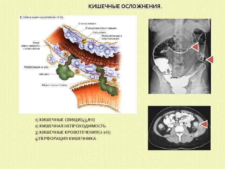 КИШЕЧНЫЕ ОСЛОЖНЕНИЯ. 1) КИШЕЧНЫЕ СВИЩИ(43, 8%) 2) КИШЕЧНАЯ НЕПРОХОДИМОСТЬ 3) КИШЕЧНЫЕ КРОВОТЕЧЕНИЯ(1 -2%) 4)ПЕРФОРАЦИЯ