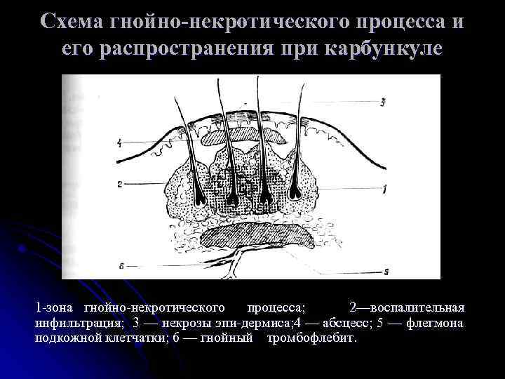 Схема гнойно-некротического процесса и его распространения при карбункуле 1 зона гнойно некротического процесса; 2—воспалительная