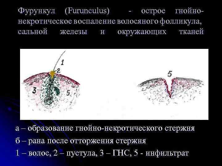 Фурункул (Furunculus) острое гнойно некротическое воспаление волосяного фолликула, сальной железы и окружающих тканей а