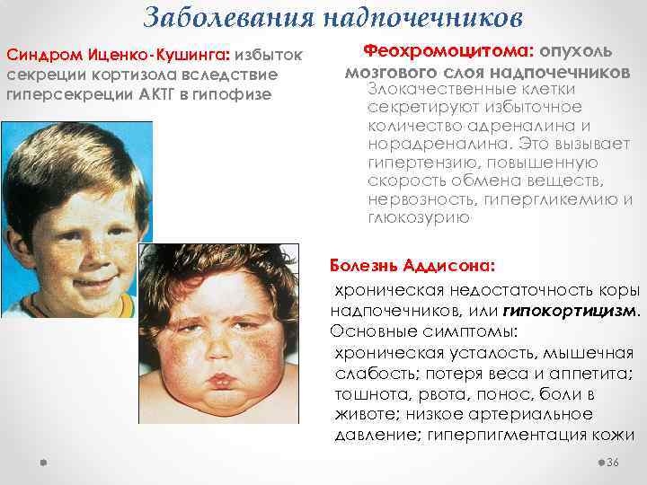 Заболевания надпочечников Синдром Иценко-Кушинга: избыток секреции кортизола вследствие гиперсекреции АКТГ в гипофизе Феохромоцитома: опухоль
