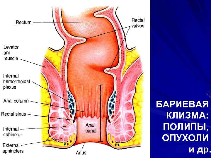БАРИЕВАЯ КЛИЗМА: ПОЛИПЫ, ОПУХОЛИ и др. 