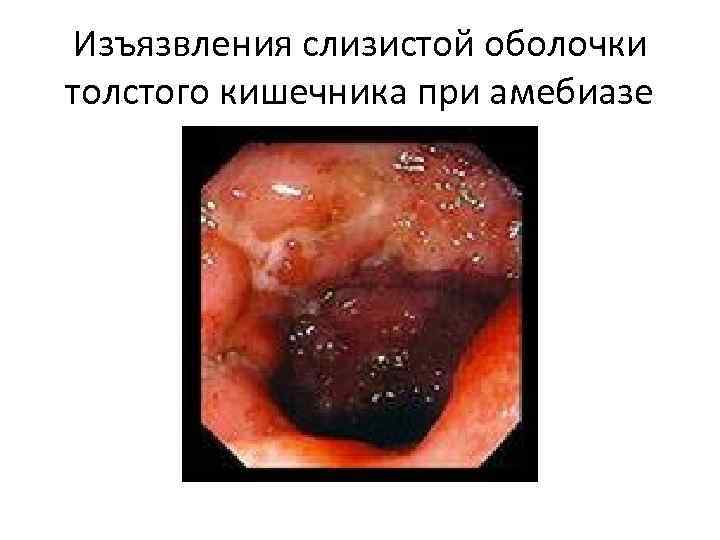 Изъязвления слизистой оболочки толстого кишечника при амебиазе 
