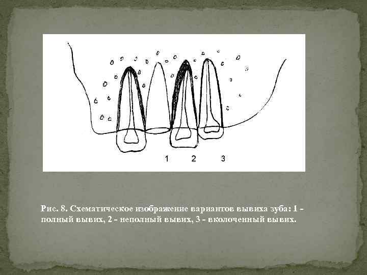 Рис. 8. Схематическое изображение вариантов вывиха зуба: 1 - полный вывих, 2 - неполный