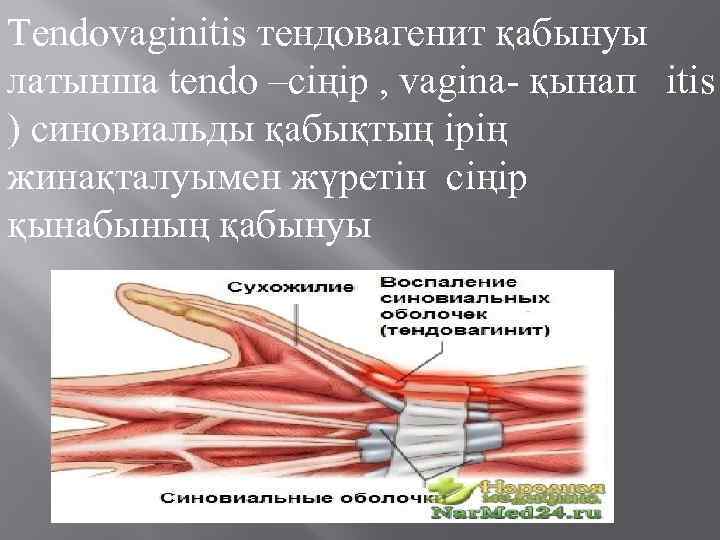 Tendovaginitis тендовагенит қабынуы латынша tendo –сіңір , vagina- қынап itis ) синовиальды қабықтың ірің