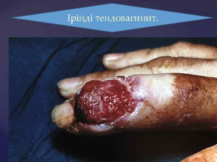 Іріңді тендовагинит. 