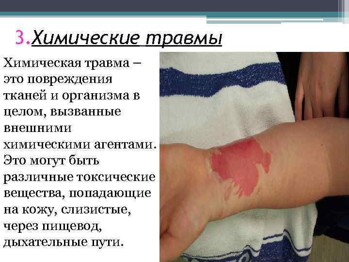 3. Химические травмы Химическая травма – это повреждения тканей и организма в целом, вызванные